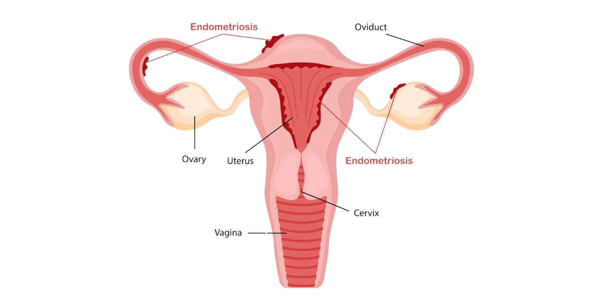 endometriosis