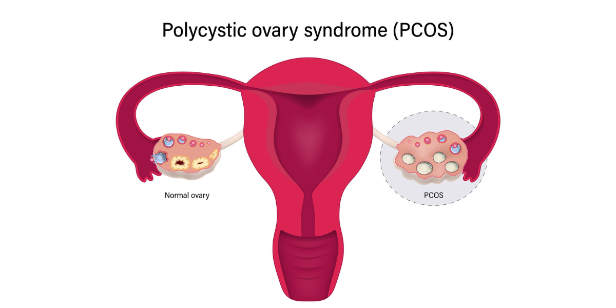 pcos